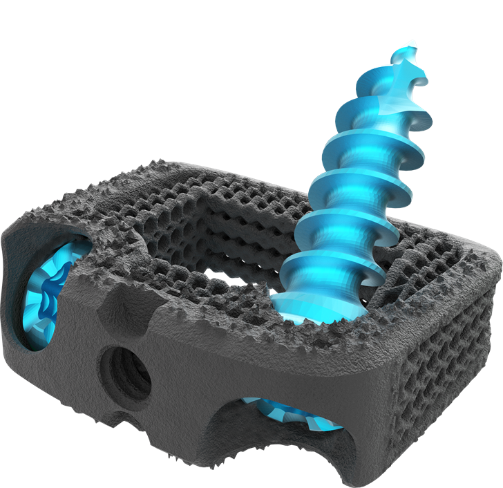 Latest 3D-Printed Device Boosts Nexxt Spine